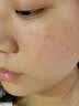 澳白汀（OHBT）氨甲环酸精华液传明酸湿敷原液医美祛斑改善暗沉黄褐斑专用50ml 实拍图