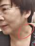 井次制药脂肪瘤专用去除神器脂肪康消除硬块脂肪粒去除皮脂腺囊肿非药膏 实拍图