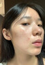 本安制药祛痘药膏青春痘祛痘淡化痘印痘坑痤疮粉刺专用青少年1盒 实拍图