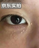 KEORKAO脂肪粒去除药膏神器眼周专用去小颗粒去汗管脂肪瘤消瘤膏清肌眼霜 实拍图