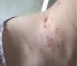 高坂制药祛疣膏疣体脱落膏扁平疣去肉除球丝状跖脖子上小肉粒专用瘊药20g 实拍图