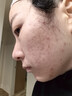 芙清壬二酸清痘精华乳15g祛痘改善黑白头粉刺毛孔修护 实拍图