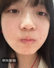 淞町制药去痣点痣膏专用脸面部不留疤祛痣膏点斑克跖疣药水正品无痛无疤痕 实拍图