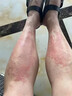 本安制药湿疹膏皮肤瘙痒皮炎皮癣真菌感染止痒去根非药膏肛门肛周潮湿1盒 实拍图