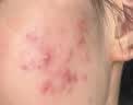 维特丝壬二酸15%凝胶祛痘膏祛痘印淡痘印水杨酸胶态硫烟酰胺乳青春期 实拍图