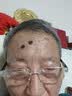 【京东大药房官方直售旗舰】点痣膏无痕药水祛痣套装黑点脸部痦子无痛黑痣斑点神器官方正品店 点痣膏（1瓶） 实拍图