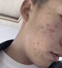 维特丝壬二酸15%凝胶祛痘膏祛痘印淡痘印水杨酸胶态硫烟酰胺乳青春期 实拍图