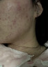 KEORKAO祛痘药膏去痘痘淡化痘印消炎痤疮专用祛痘精华青少年青春痘试用装 实拍图