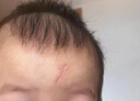 沃朗森祛疤膏去疤痕专用修复儿童医院硅酮凝胶医用手术缝针除疤药膏 1盒 实拍图