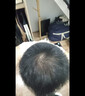 蔓迪【二代米诺地尔】蔓迪5%生发泡沫60g*2（敏皮专属 温和不油腻）男女士快速防脱育发米洛原液搽剂酊曼迪 实拍图