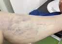 葵花静脉曲张贴专用改善蚯蚓腿疏通血管堵塞肿胀痛搭弹力袜膏药贴6贴 实拍图