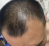 蔓迪【二代米诺地尔】蔓迪5%生发泡沫60g*2（敏皮专属 温和不油腻）男女士快速防脱育发米洛原液搽剂酊曼迪 实拍图