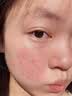 透真水杨酸祛痘精华液去粉刺去闭口修复淡化痘印痘坑痘疤敏感肌男女士 实拍图