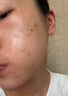 KEORKAO祛痘药膏去痘痘淡化痘印消炎痤疮专用祛痘精华青少年青春痘试用装 实拍图