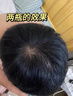 KOOGIS米诺地尔上药器头皮上药器非泡沫剂滚珠按摩涂抹上药精华液导入梳 实拍图