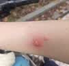涩冈制薬蚊虫叮咬止痒消肿儿童婴幼儿专用驱除防蚊液止痒消肿湿疹药膏 实拍图