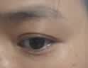 小菱制药脂肪粒去除药膏眼周专用去除神器去小颗粒汗管瘤无痛溶解不留疤 实拍图