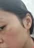 华美科医用重组人体表皮生长因子点痣疤痕修复凝胶烫软膏伤口愈合15g1支 实拍图