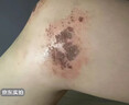 PENGRDOCTOR祛疤膏儿童去祛疤痕专用修复医用硅酮除疤生长因子凝胶膏剖腹产贴 实拍图