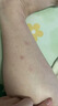 鸡皮肤疙瘩毛囊角化专用去除大腿胳膊手臂药膏身体乳霜毛周角化症 单盒装【鸡皮肤克星】 角质化增生专用的药磨砂膏去除神器 实拍图