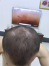 蔓迪【二代米诺地尔】蔓迪5%生发泡沫剂60g(倍速温和生发)男士专用治脱发防脱洗发水育发米洛原液酊搽剂 实拍图