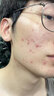维特丝壬二酸15%凝胶祛痘膏祛痘印淡痘印水杨酸胶态硫烟酰胺乳青春期 实拍图