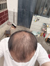 蔓迪【二代米诺地尔】蔓迪5%生发泡沫剂60g(倍速温和生发)男士专用治脱发防脱洗发水育发米洛原液酊搽剂 实拍图