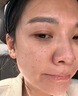OHBT壬二酸15%凝胶水杨酸祛痘药膏祛痘淡化痘印坑消炎痤疮专用青少年 实拍图