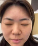 OHBT壬二酸15%凝胶水杨酸祛痘药膏祛痘淡化痘印坑消炎痤疮专用青少年 实拍图
