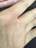 硬核医生克林霉素甲硝唑搽剂磷酸脂喷剂溶液55ml 治毛囊炎脂溢性皮炎寻常痤疮祛痘脓包马拉色菌真菌感染 实拍图