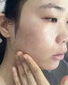OHBT壬二酸15%凝胶水杨酸祛痘药膏祛痘淡化痘印坑消炎痤疮专用青少年 实拍图