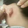 DR.MICKEY制药祛去疣体脱落膏扁平疣跖疣尖锐湿丝状疣瘊灵脖子肉粒颈部 实拍图