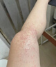 本安制药湿疹膏皮肤瘙痒皮炎皮癣真菌感染止痒去根非药膏肛门肛周潮湿1盒 实拍图