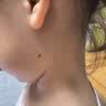 高坂制药点痣膏点斑祛疣药水脸部去黑痣扁平跖疣修复液无痕不留疤非药5ml 实拍图