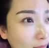 华美科医用重组人体表皮生长因子点痣疤痕修复凝胶烫软膏伤口愈合15g1支 实拍图