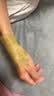 宝芝林膏药贴腱鞘炎手腕手指腱鞘疼痛囊肿鼓包热敷专用远红外理疗贴 8贴 实拍图