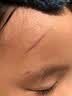 BKWILD医用重组生长因子凝胶胶原蛋白点痣喷人表祛疤痕膏修复生肌膏 实拍图