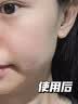澳喜卡博士医用面部护理敷料洗面奶控油祛痘除螨虫去黑头痤疮洁面乳 1支装 实拍图