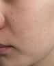 高坂制药点痣膏点斑祛疣药水脸部去黑痣扁平跖疣修复液无痕不留疤非药5ml 实拍图