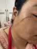 BKWILD美国进口硅酮祛疤膏去疤痕修复除疤医用硅酮凝胶剖腹产手术缝针 实拍图