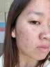 维特丝壬二酸15%凝胶祛痘膏祛痘印淡痘印水杨酸胶态硫烟酰胺乳青春期 实拍图