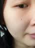 李护士医用黑色素沉淀祛痘印黑印去疤印淡化修护皮肤祛疤痕膏增生疤1支 实拍图