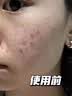 澳喜卡博士医用面部护理敷料洗面奶控油祛痘除螨虫去黑头痤疮洁面乳 1支装 实拍图