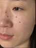 高坂制药点痣膏点斑祛疣药水脸部去黑痣扁平跖疣修复液无痕不留疤非药5ml 实拍图