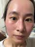 沃朗森医用面膜械字号冷敷贴医美术后补水修复祛痘印消炎透明质酸钠3盒 实拍图