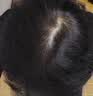 蔓迪【独家获批】蔓迪二代米诺地尔5%生发泡沫剂60g*3男女专用治脱发防脱洗发水育发米洛酊搽剂 实拍图