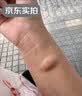 井次制药脂肪瘤专用去除神器脂肪康消除硬块脂肪粒去除皮脂腺囊肿非药膏 实拍图