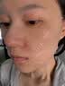 沃朗森医用面膜械字号冷敷贴医美术后补水修复祛痘印消炎透明质酸钠3盒 实拍图
