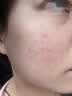 维特丝水杨酸祛痘精华淡化痘印去痘痘收毛孔男女护肤青春期学生专用30g 实拍图