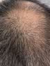 蔓迪生发喷雾90ml*4瓶【超值量贩装】5%米诺地尔酊男士专用治脱发育发斑秃原液搽剂曼迪京东自营米洛 实拍图